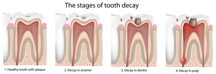 Tooth Colored Dental Implants