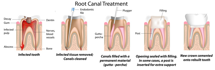 Root Canal Therapy Procedure | Root Canal Therapy in Houston, TX