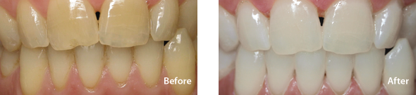 Before & After Professional Teeth Whitening
